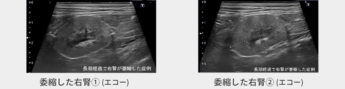 慢性腎臓病で右腎が委縮した症例