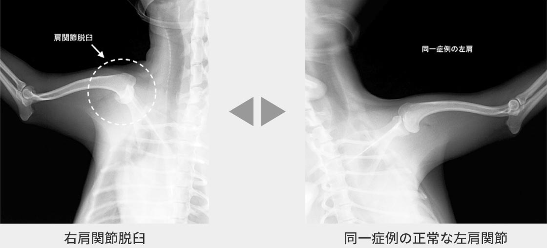 右肩関節脱⾅の症例