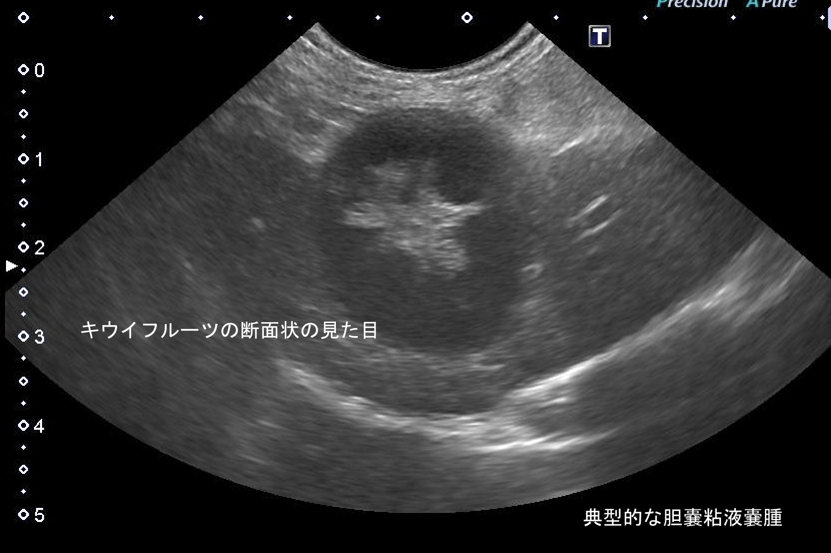 胆嚢粘液嚢腫 超音波検査